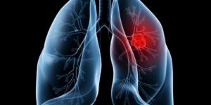 Leia mais sobre o artigo Saiba o que é adenocarcinoma pulmonar, câncer que atinge o Papa Leão XIV